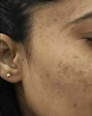 Pigmentation