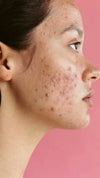 Acne/ Breakouts