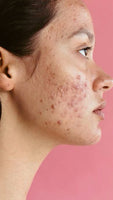 Acne/ Breakouts